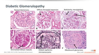 Diabetic Glomerulopathy
Alicic. CJASN. 2017;12:2032. Reproduced with permission. Slide credit: clinicaloptions.com
Normal Glomerulus Diffuse mesangial expansion Nodularity, mesangiolysis
Kimmelstiel-Wilson nodules Dilated capillaries-
microaneurysms
Obsolescent glomerulus
 