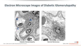 Electron Microscope Images of Diabetic Glomerulopathy
Alicic. CJASN. 2017;12:2032. Reproduced with permission. Slide credit: clinicaloptions.com
 