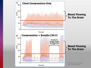 Ewy GA, et al. Circulation.
2007;116(22):2525-30.
Blood Flowing
To The Brain
Blood Flowing
To The Brain
Chest Compressions Only
Compressions + Breaths (30:2)
Pausing for
breaths means
No Blood Flow
 