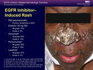 clinicaloptions.com/oncology
EGFR Inhibitor–Related Dermatologic Toxicities
1. Lacouture ME, et al. Br J Dermatol. 2006;155:852-854.
2. Shepherd FA, et al. N Engl J Med. 2005; 353:123-132.
3. Rosell R, et al. Ann Oncol. 2008;19:362-369.
4. Van Cutsem E, et al. J Clin Oncol. 2007;25:1658-1664.
5. Geyer CE, et al. N Engl J Med. 2006;355:2733-2743.
EGFR Inhibitor–
Induced Rash
 Red papulopustules[1]
– Pruritus, tenderness in 62%
 Erlotinib 150 mg QD[2]
– All grade: 75%
– Grade 3: 9%
 Cetuximab[3]
– All grade: 85%
– Grade 3: 10%
 Panitumumab[4]
– All grade: 90%
– Grade 3: 16%
 Lapatinib[5]
– All grade: 27%
– Grade 3: 1%
 