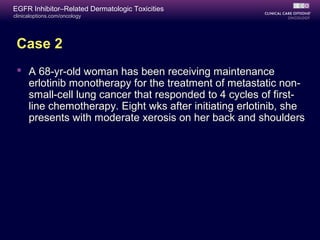 clinicaloptions.com/oncology
EGFR Inhibitor–Related Dermatologic Toxicities
Case 2
 A 68-yr-old woman has been receiving maintenance
erlotinib monotherapy for the treatment of metastatic non-
small-cell lung cancer that responded to 4 cycles of first-
line chemotherapy. Eight wks after initiating erlotinib, she
presents with moderate xerosis on her back and shoulders
 