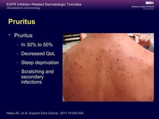 clinicaloptions.com/oncology
EGFR Inhibitor–Related Dermatologic Toxicities
Pruritus
 Pruritus
– In 30% to 50%
– Decreased QoL
– Sleep deprivation
– Scratching and
secondary
infections
Haley AC, et al. Support Care Cancer. 2011;19:545-554.
 