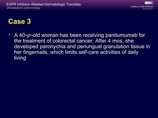 clinicaloptions.com/oncology
EGFR Inhibitor–Related Dermatologic Toxicities
Case 3
 A 40-yr-old woman has been receiving panitumumab for
the treatment of colorectal cancer. After 4 mos, she
developed paronychia and periungual granulation tissue in
her fingernails, which limits self-care activities of daily
living
 