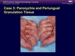clinicaloptions.com/oncology
EGFR Inhibitor–Related Dermatologic Toxicities
Case 3: Paronychia and Periungual
Granulation Tissue
 