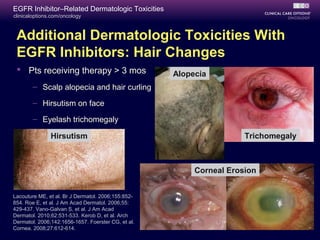 clinicaloptions.com/oncology
EGFR Inhibitor–Related Dermatologic Toxicities
Trichomegaly
Alopecia
Hirsutism
Corneal Erosion
Additional Dermatologic Toxicities With
EGFR Inhibitors: Hair Changes
 Pts receiving therapy > 3 mos
– Scalp alopecia and hair curling
– Hirsutism on face
– Eyelash trichomegaly
Lacouture ME, et al. Br J Dermatol. 2006;155:852-
854. Roe E, et al. J Am Acad Dermatol. 2006;55:
429-437. Vano-Galvan S, et al. J Am Acad
Dermatol. 2010;62:531-533. Kerob D, et al. Arch
Dermatol. 2006;142:1656-1657. Foerster CG, et al.
Cornea. 2008;27:612-614.
 