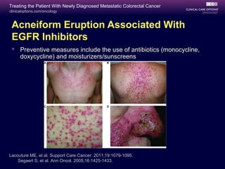 Treating the Patient With Newly Diagnosed Metastatic Colorectal Cancer
clinicaloptions.com/oncology



 Acneiform Eruption Associated With
 EGFR Inhibitors
  Preventive measures include the use of antibiotics (monocycline,
   doxycycline) and moisturizers/sunscreens




Lacouture ME, et al. Support Care Cancer. 2011;19:1079-1095.
    Segaert S, et al. Ann Oncol. 2005;16:1425-1433.
 