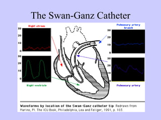 The Swan-Ganz Catheter
 