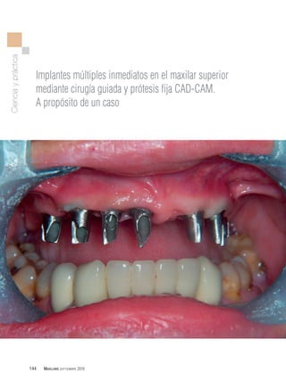 Cienciaypráctica
144 MAXILLARIS SEPTIEMBRE 2016
Implantes múltiples inmediatos en el maxilar superior
mediante cirugía guiada y prótesis fija CAD-CAM.
A propósito de un caso
 