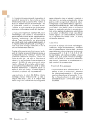 Implantes múltiples inmediatos en el maxilar superior mediante cirugía ...