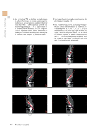 Implantes múltiples inmediatos en el maxilar superior mediante cirugía ...