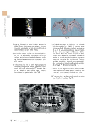 Implantes múltiples inmediatos en el maxilar superior mediante cirugía ...
