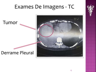 Exames De Imagens - TC 
12 
Tumor 
Derrame Pleural 
 