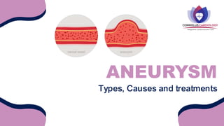 Types, Causes and treatments
ANEURYSM
 