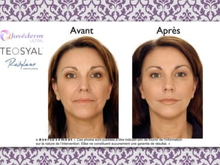 Avant Après «  Avertissement :  Ces photos sont publi é es  à  titre indicatif afin de fournir de l ’ information  sur la nature de l’intervention. Elles ne constituent aucunement une garantie de résultat. » 