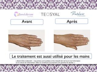Avant Après Le traitement est aussi utilisé pour les mains «  Avertissement :  Ces photos sont publi é es  à  titre indicatif afin de fournir de l ’ information  sur la nature de l’intervention. Elles ne constituent aucunement une garantie de résultat. » 