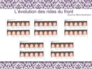L’évolution des rides du front Grade 0 Grade 2 Grade 1 Grade 4 Grade 3 (Source: Merz Aesthetic) 
