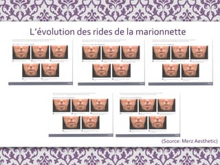 L’évolution des rides de la marionnette Grade 0 Grade 2 Grade 1 Grade 4 Grade 3 (Source: Merz Aesthetic) 