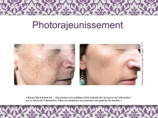 «  Avertissement :  Ces photos sont publi é es  à  titre indicatif afin de fournir de l ’ information  sur la nature de l’intervention. Elles ne constituent aucunement une garantie de résultat. » Photorajeunissement 
