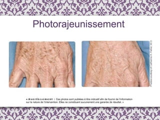 «  Avertissement :  Ces photos sont publi é es  à  titre indicatif afin de fournir de l ’ information  sur la nature de l’intervention. Elles ne constituent aucunement une garantie de résultat. » Photorajeunissement 