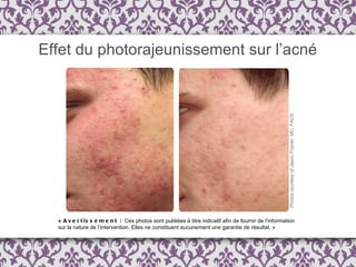 Effet du photorajeunissement sur l’acné «  Avertissement :  Ces photos sont publi é es  à  titre indicatif afin de fournir de l ’ information  sur la nature de l’intervention. Elles ne constituent aucunement une garantie de résultat. » 