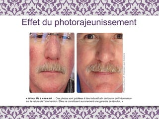 Effet du photorajeunissement  «  Avertissement :  Ces photos sont publi é es  à  titre indicatif afin de fournir de l ’ information  sur la nature de l’intervention. Elles ne constituent aucunement une garantie de résultat. » 