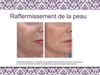 Raffermissement de la peau «  Avertissement :  Ces photos sont publi é es  à  titre indicatif afin de fournir de l ’ information  sur la nature de l’intervention. Elles ne constituent aucunement une garantie de résultat. » 