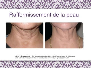 Raffermissement de la peau «  Avertissement :  Ces photos sont publi é es  à  titre indicatif afin de fournir de l ’ information  sur la nature de l’intervention. Elles ne constituent aucunement une garantie de résultat. » 