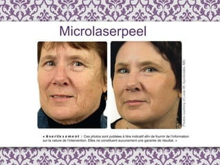 «  Avertissement :  Ces photos sont publi é es  à  titre indicatif afin de fournir de l ’ information  sur la nature de l’intervention. Elles ne constituent aucunement une garantie de résultat. » Microlaserpeel 