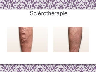Sclérothérapie 