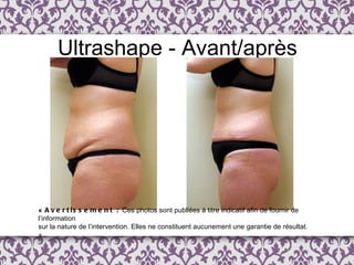 Ultrashape - Avant/après «  Avertissement :  Ces photos sont publi é es  à  titre indicatif afin de fournir de l ’ information  sur la nature de l’intervention. Elles ne constituent aucunement une garantie de résultat. » 