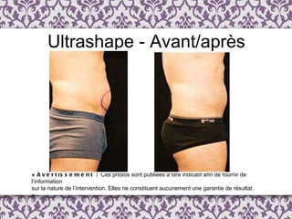 Ultrashape - Avant/après «  Avertissement :  Ces photos sont publi é es  à  titre indicatif afin de fournir de l ’ information  sur la nature de l’intervention. Elles ne constituent aucunement une garantie de résultat. » 