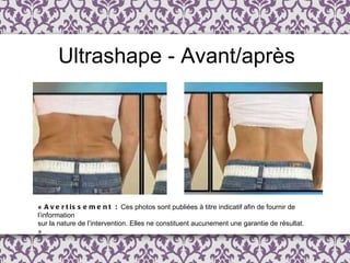Ultrashape - Avant/après «  Avertissement :  Ces photos sont publi é es  à  titre indicatif afin de fournir de l ’ information  sur la nature de l’intervention. Elles ne constituent aucunement une garantie de résultat. » 