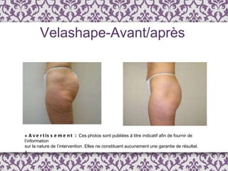 Velashape-Avant/après «  Avertissement :  Ces photos sont publi é es  à  titre indicatif afin de fournir de l ’ information  sur la nature de l’intervention. Elles ne constituent aucunement une garantie de résultat. » 
