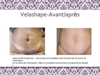 Velashape-Avant/apr è s «  Avertissement :  Ces photos sont publi é es  à  titre indicatif afin de fournir de l ’ information  sur la nature de l’intervention. Elles ne constituent aucunement une garantie de résultat. » 
