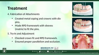 Attachment Retained Rpd Innovative Custom Attachment System for Retentive Removable Prosthesis ...