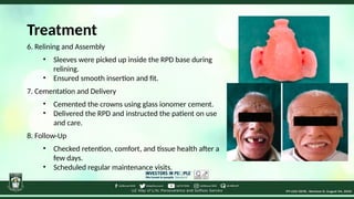 Relining In Rpd Innovative Custom Attachment System for Retentive Removable Prosthesis ...