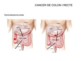 CANCER DE COLON I RECTE Hemicolectomia dreta 