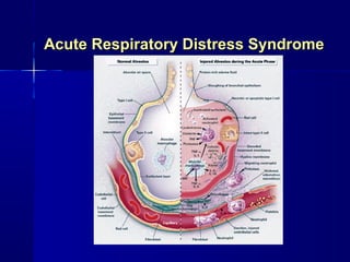 Acute Respiratory Distress Syndrome
 