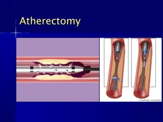 Atherectomy
 