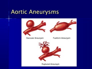 Aortic Aneurysms
 