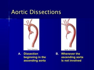 Aortic Dissections




  A. Dissection         B. Whenever the
     beginning in the      ascending aorta
     ascending aorta       is not involved
 