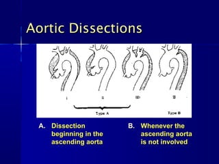 Aortic Dissections




 A. Dissection         B. Whenever the
    beginning in the      ascending aorta
    ascending aorta       is not involved
 