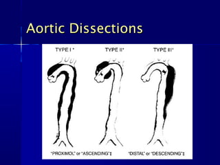 Aortic Dissections
 