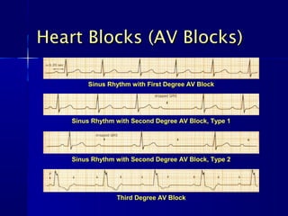 Heart Blocks (AV Blocks)

        Sinus Rhythm with First Degree AV Block




    Sinus Rhythm with Second Degree AV Block, Type 1




    Sinus Rhythm with Second Degree AV Block, Type 2




                 Third Degree AV Block
 