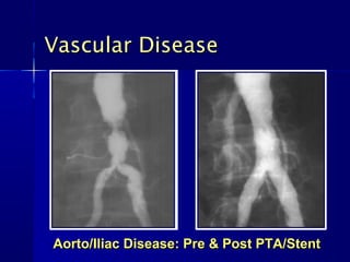 Vascular Disease




Aorto/Iliac Disease: Pre & Post PTA/Stent
 