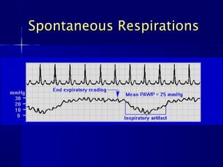 Spontaneous RespirationsSpontaneous Respirations
 