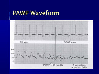 PAWP WaveformPAWP Waveform
 