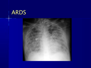 ARDSARDS
 