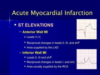 
ST ELEVATIONSST ELEVATIONS
– Anterior Wall MIAnterior Wall MI
 Leads VLeads V11-V-V44

Reciprocal changes in leads II, III, and aVFReciprocal changes in leads II, III, and aVF

Area supplied by the LADArea supplied by the LAD
– Inferior Wall MIInferior Wall MI

Leads II, III and aVFLeads II, III and aVF

Reciprocal changes in leads I, and aVLReciprocal changes in leads I, and aVL

Area usually supplied by the RCAArea usually supplied by the RCA
Acute Myocardial InfarctionAcute Myocardial Infarction
 