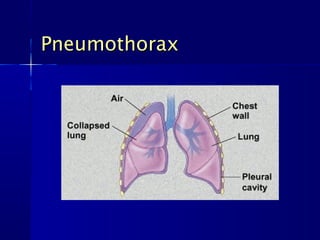 PneumothoraxPneumothorax
 